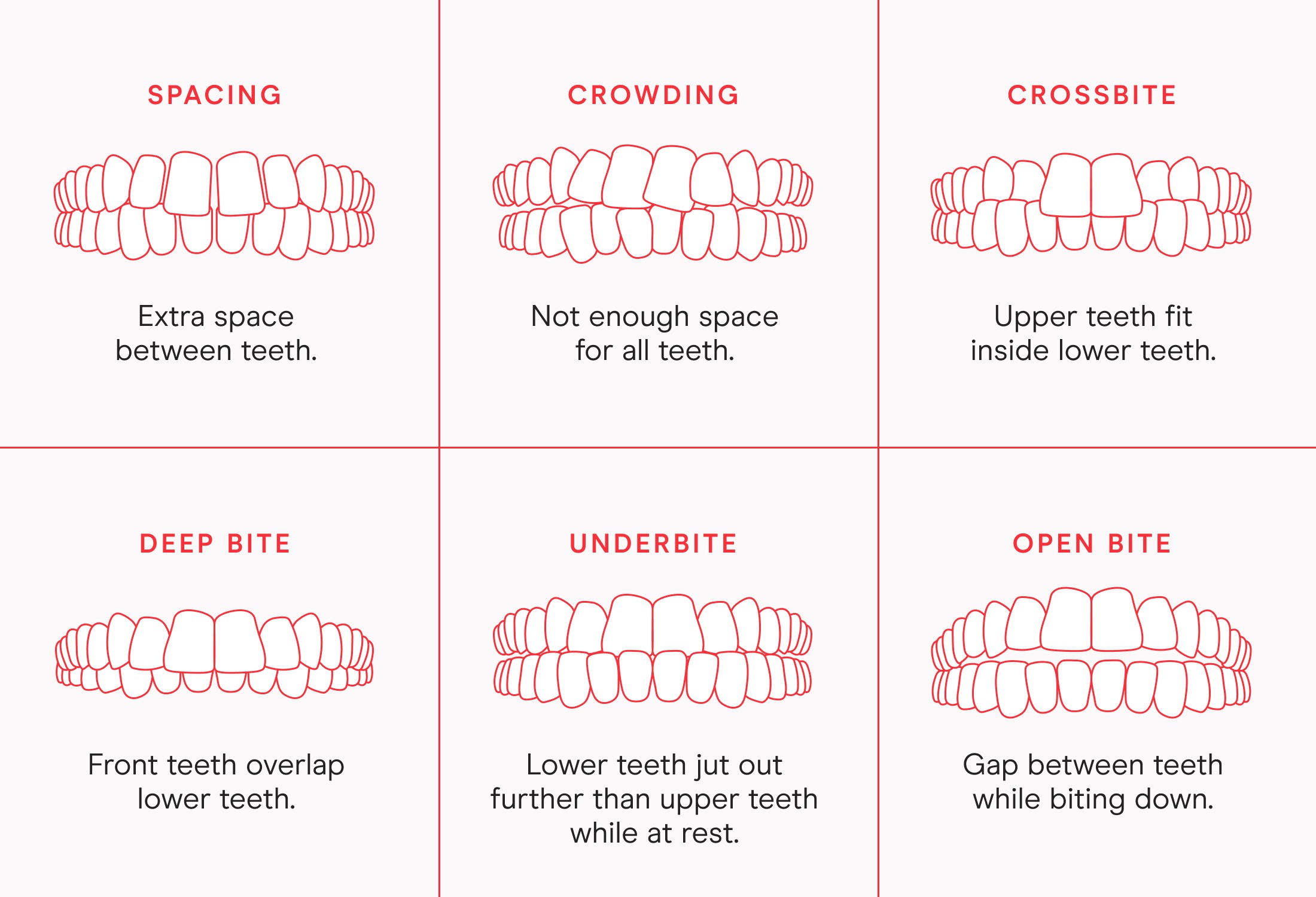 Malocclusion-Chart