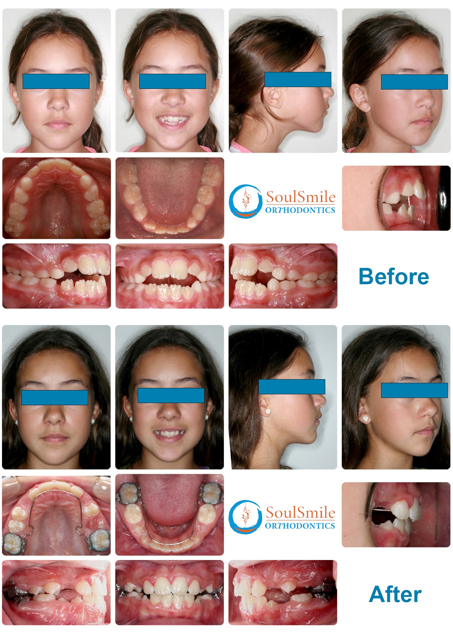 Open Bite Phase I